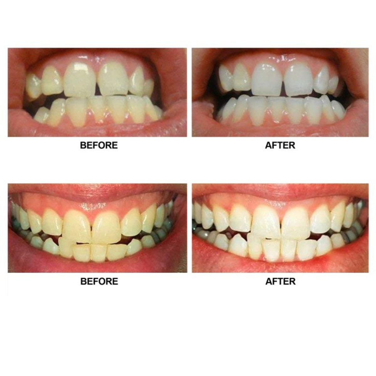 (AuraGlow®) Teeth Whitening Light ชุดฟอกฟันขาว เครื่องฟอกสีฟัน