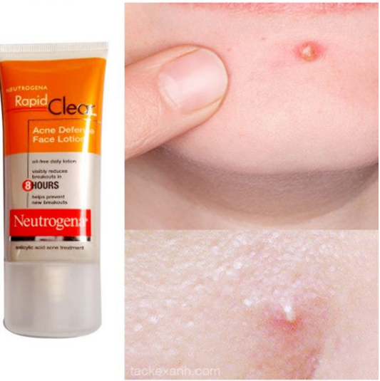 (Pre Order) Neutrogena® Rapid Clear Acne Defense Face Lotion 50ml โลชั่นบำรุงหน้าเนื้อบางเบา ลดสิว