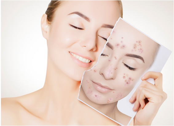 (Pre Order) Neutrogena® Rapid Clear Oil-Eliminating Foaming Cleanser 177ml นูโทรจีน่า โฟมล้างหน้าลดความมัน