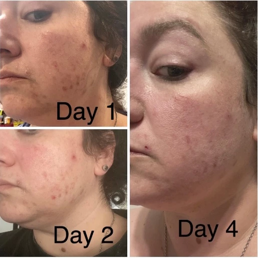 Neutrogena® Rapid Clear Stubborn Acne Spot Gel Maximum Strength 28 g เจลแต้มสิว นูโทรจีน่า